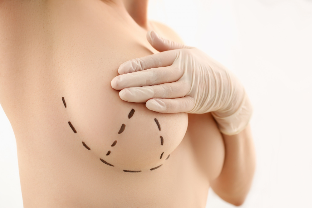 Breast Reduction (Mammoplasty)