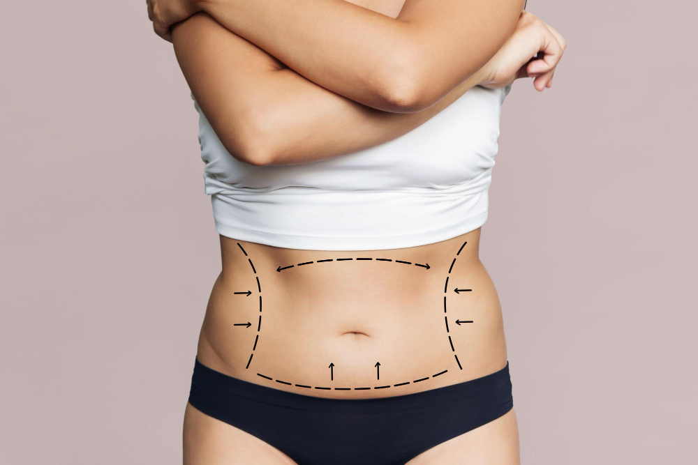 Fat Removal (Liposuction)